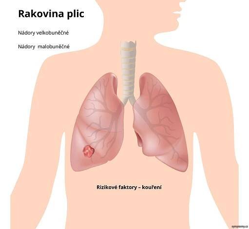 Rakovina plic - příznaky a léčba