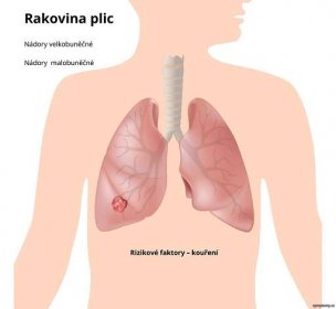 Rakovina plic - příznaky a léčba