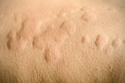 Kožní vyrážka, kopřivka, alergická reakce poko�žky. — Stock fotografie