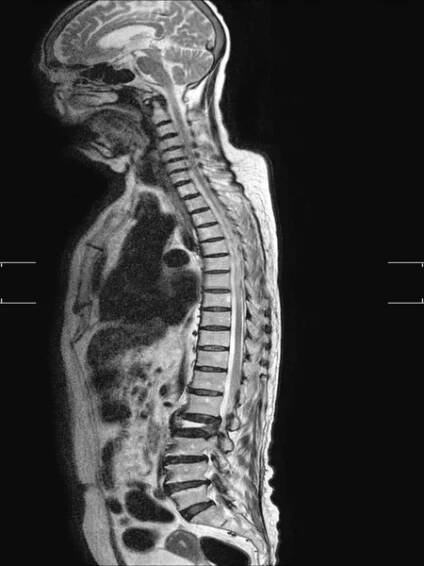 MRI bederní páteře Studie odhalila zlomeninu obratle L2, která se jeví jako závažná snížená výška kotouče a rozšíření interpedikulární vzdálenosti. — Stock obrázek