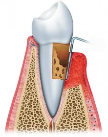 Stáhnout - Gingivitida v pokročilém stadiu zhoršení stavu dásní a zubů — Stock obrázek