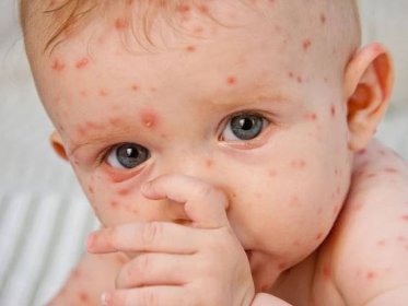 Co je to plané neštovice a jak ji léčit u dětí?