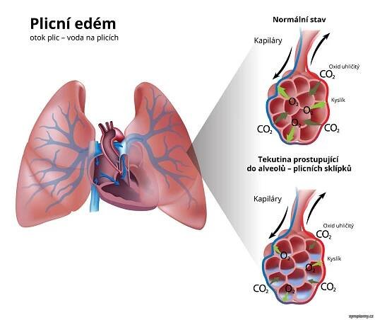 Plicní edém - příznaky a léčba