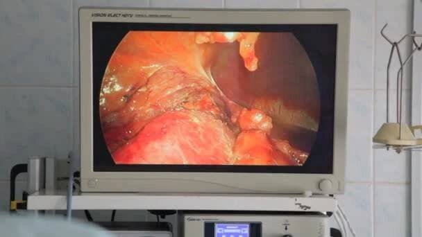 Vinnitsa, Ukrajina, 10 dubna 2018: Odstranění maligní tumor ledviny. Resekce ledviny. Lékaři týmu ruce během laparoskopické operace břicha. — Stock záběr