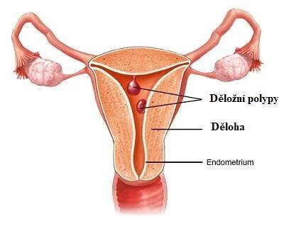 Děložní polypy - jejich příznaky, příčiny, diagnostika a léčba