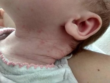 Vyrážka na krku u novorozence. Co by to mohlo být?
