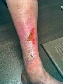 Leg ulcer and discoloration before