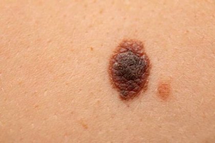 nebezpečný névus na kůži - melanom - melanom - stock snímky, obrázky a fotky