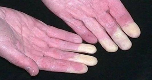 Tajemství bílých prstů: Postihují 5 až 8 % populace a rozhodně nevěstí nic dobrého. Raynaudův syndrom je velmi nepříjemný nepřítel