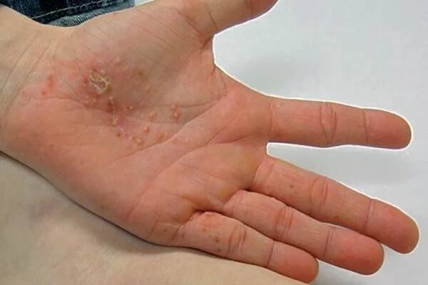 SKIN ALLERGY | Allergy Medik