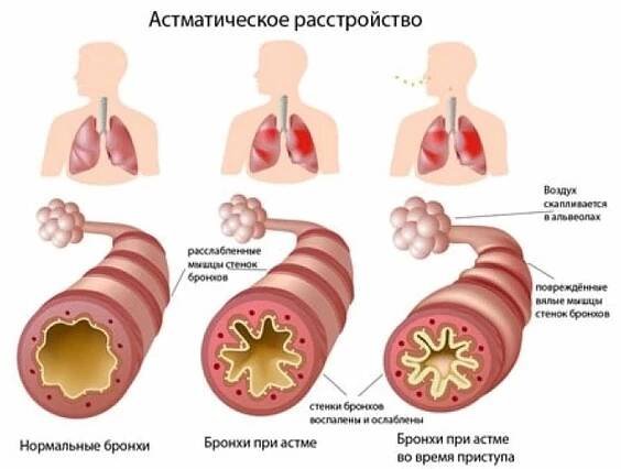 Astma - není věta základních principů léčby bronchiálního astmatu / Články