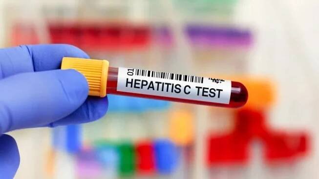 Hepatitidou C se můžete nakazit opakovaně. Kdy má smysl si říct o test?