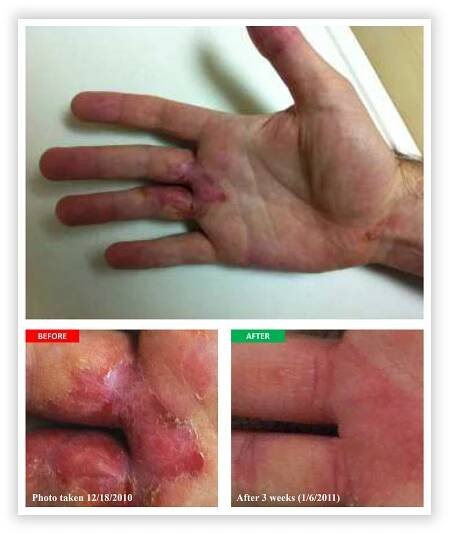 Eczema Case Study – Brewer Wellness