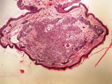 Soubor:Capillary haemangioma skin kapilarni hemangiom kuze 4x.jpg – WikiSkripta