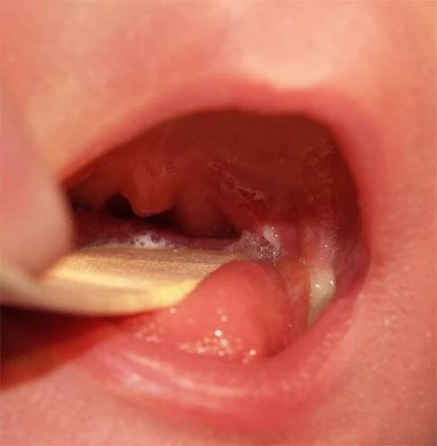 Bifid uvula