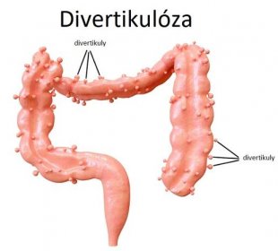 Divertikulóza je stav, při kterém se v tlustém střevě tvoří malé výběžky z vnitřní stěny střeva, nazývané divertikuly