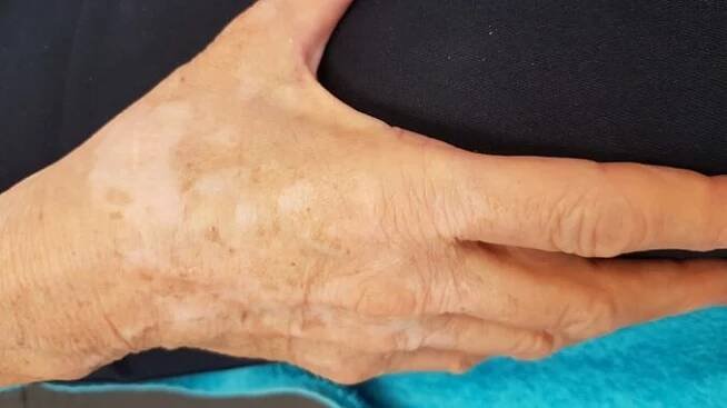 stara-ruka-vitiligo