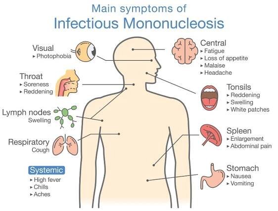 Symptomy infekční mononukleózy: citlivost očí, bolest v krku, zvětšení lymfatických uzlin, zhoršené dýchání, horečka, vyčerpání, nechutenství, malátnost, bolest hlavy, otok mandlí, bolest břicha, nevolnost, pocit na zvracení. Zdroj: Getty Images