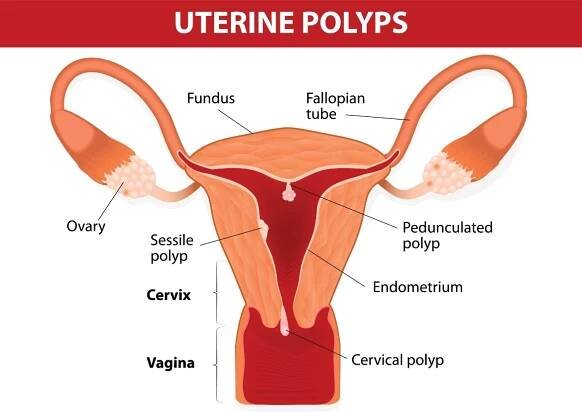 Děložní polypy. Ovary (vaječník), Fundus (dno dělohy). Fallopaian tube (vejcovod). Cervix (děložní čípek), Vagina (pochva), Endometrium (sliznice dělohy). Děložní polypy: Sessile polyp (přisedlý polyp), Pedunculated polyp (stopkatý polyp), Cervical polyp (polyp děložního hrdla). Zdroj: Getty Images