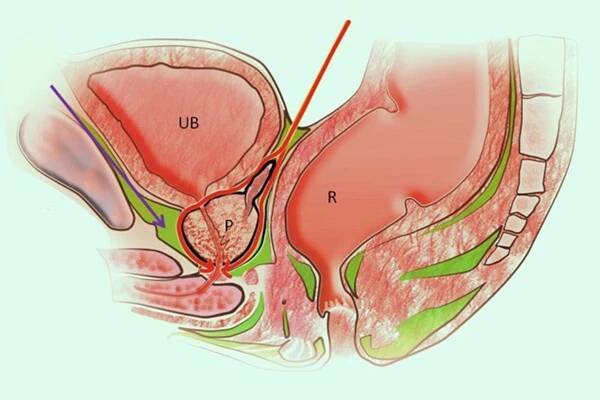 Robot-Assisted Radical Prostatectomy