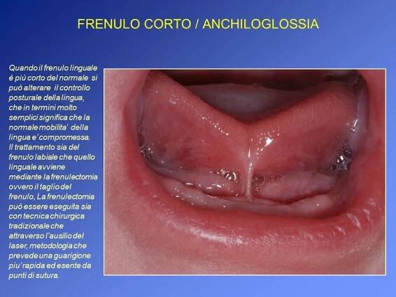 FRENULO CORTO ANCHILOGLOSSIA 2