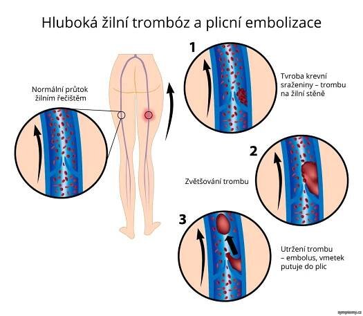 Hluboká žilní trombóz a plicní embolizace