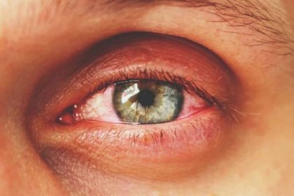 POZOR: Slzí vám často oči? Je to projev riskantních problémů pro váš zrak - ochraňte se před SLEPOTOU včas tím, že si sami vyhodnotíte tuhle nejčastější příčinu!