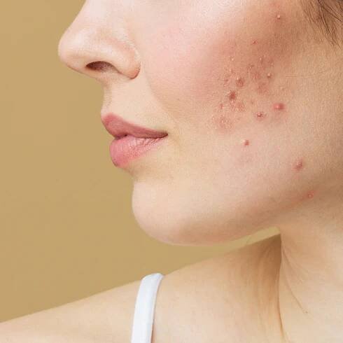 Dermatologist Reveals the One Thing You Should Never Do to a Pimple