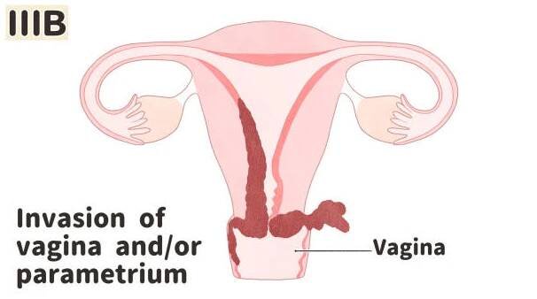 rakovina endometria (rakovina dělohy) diagram stadia 3b - endometritida ilustrace stock ilustrace