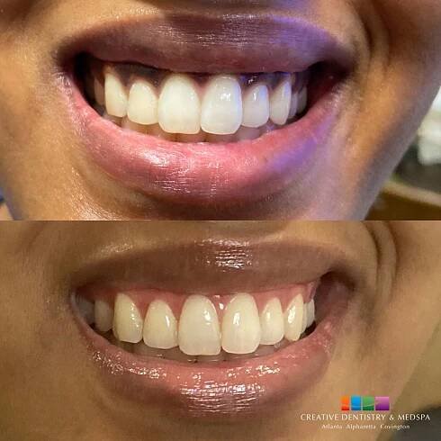 patient before and after Gum Bleaching procedure
