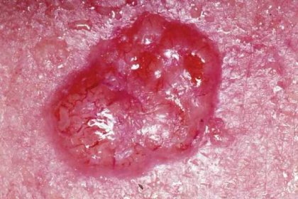 Soubor:Basal cell carcinoma.jpg – Wikipedie