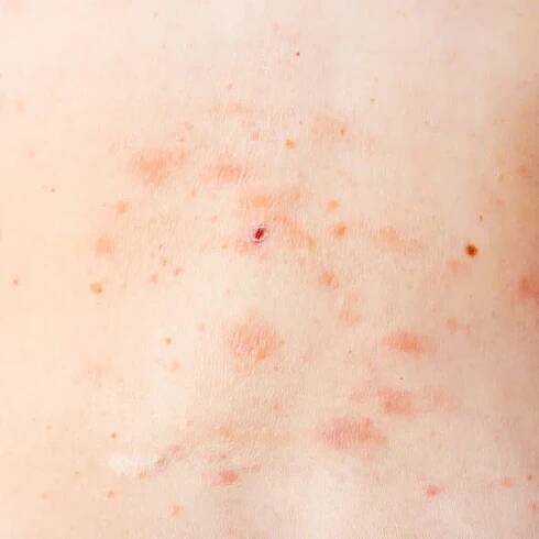 Kožní vyrážka léčba na těle ženy. pásový opar, choroba, herpes zoster, virus varicella-zoster. kožní vyrážka a puchýře na těle — Stock obrázek
