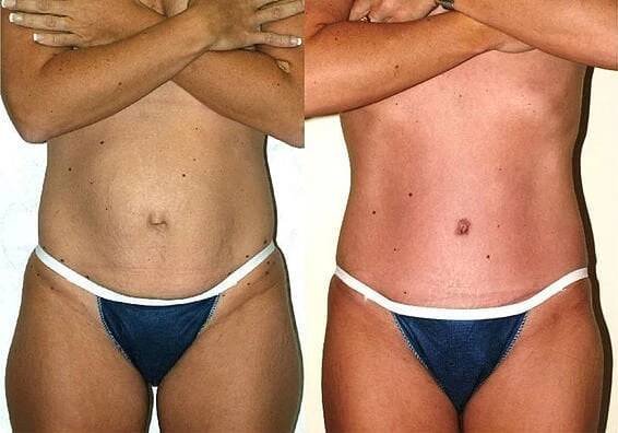 Problém se také někdy řeší abdominoplastikou - estetickou operací břicha