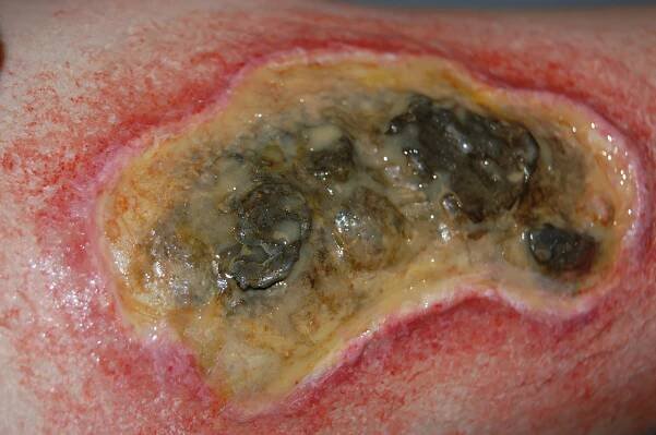 Large Ulcer