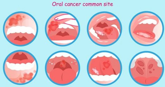 Rakovina dutiny ústní a místa výskytu nádoru. Zdroj: Getty images