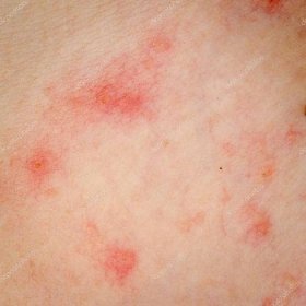 Stáhnout - Nemocný alergická vyrážka dermatitida ekzémy kůže pacienta — Stock obrázek