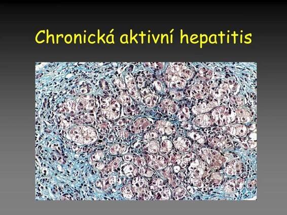 PPT - Nemoci jater a žlučníku PowerPoint Presentation, free download - ID:5513998