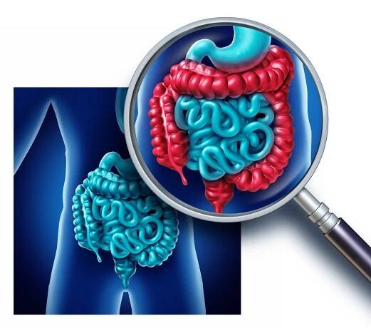 Microscopic Colitis Raises Risk for Cardiac Events