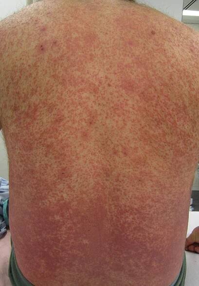 Cutaneous small-vessel vasculitis - Wikipedia