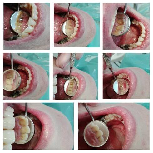 Dentální hygiena, Praha 4, Dentální hygiena Praha, Beáta Turková, DiS., Bělení zubů ZOOM!, Zubní hygiena, Pískování zubů