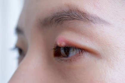 zblízka asijské mladé ženy s hnědým okem s infekcí stye. absces očních víček, hordeolum v lékařském zdraví, nemoci a koncepci léčby. - ječné zrno - stock snímky, obrázky a fotky