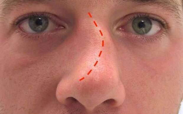  Augmentation or reduction rhinoplasty