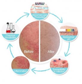 TrueLipids Eczema Complete Care – Cheryl Lee MD Sensitive Skin Care 