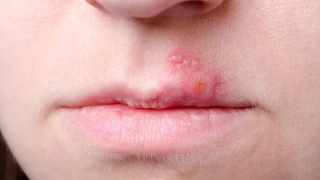 herpes-na-rtech