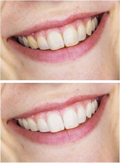 bleaching-vorher-nachher