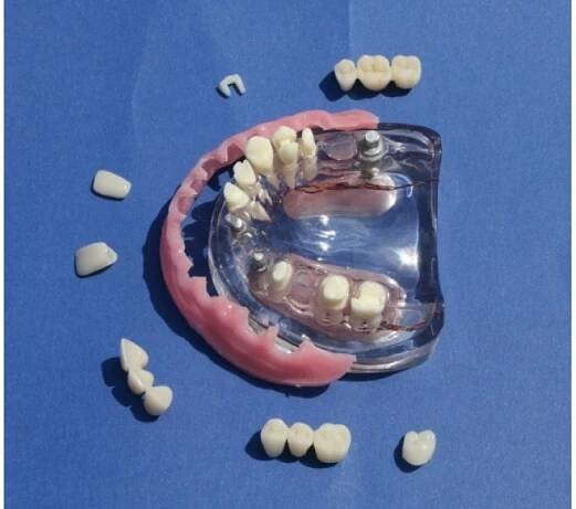 MDO-54 - Fixní protéza implantátu