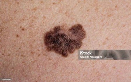 Melanom - maligní nádor kůže - Bez autorských poplatků Melanom - Rakovina kůže Stock fotka