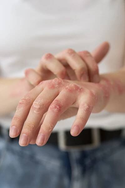 Identify & Avoid Triggers to Manage Eczema & Atopic Dermatitis