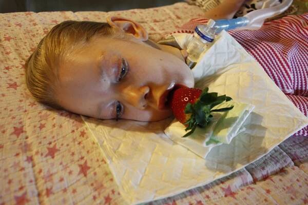 MÍŠNÍ SVALOVÁ ATROFIE TYP 1 - SMA 1, SVALOVÁ ATROFIE