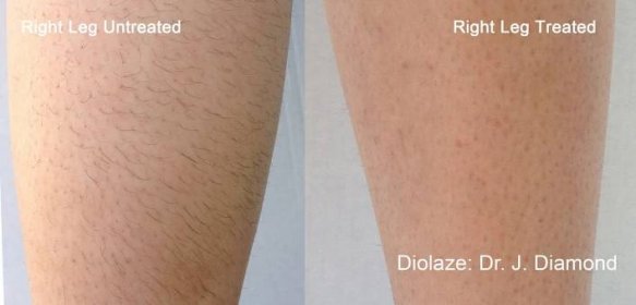 Laserová epilace odstranění chloupků na nohách před a po
